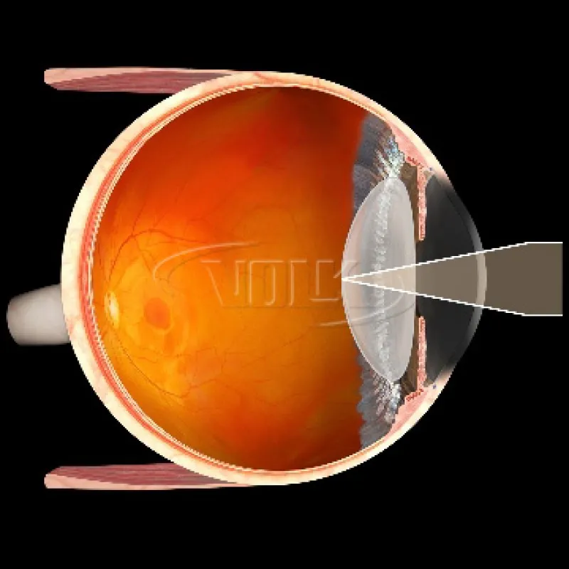 Купити Capsulotomy Україна