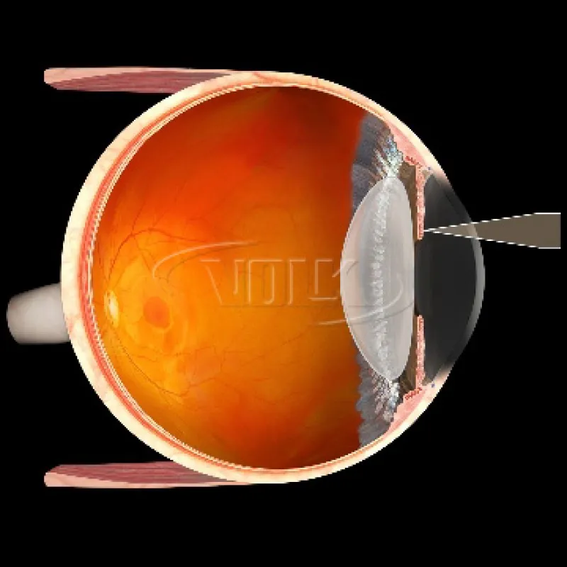 Купити Iridectomy Україна