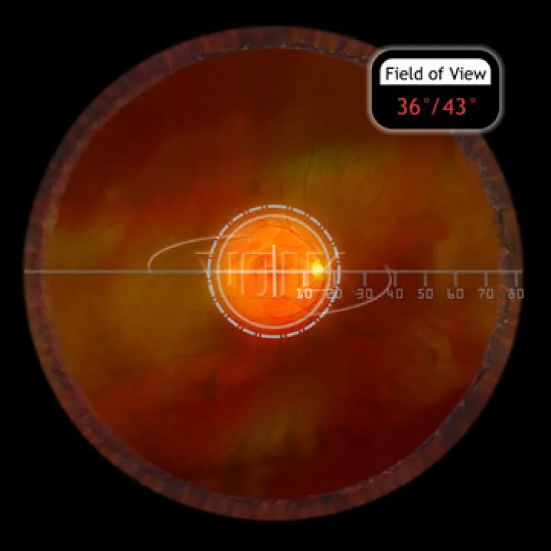 Купити Класична лінза Macula Plus® 5.5 Україна
